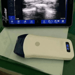 Wireless Ultrasound Probe