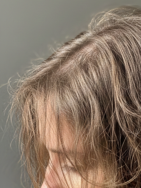 Elevexo Hair Exosome Therapy for Hair Restoration