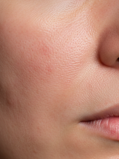 Elevexo Skin exosome therapy for skin rejuvenation and healthier skin