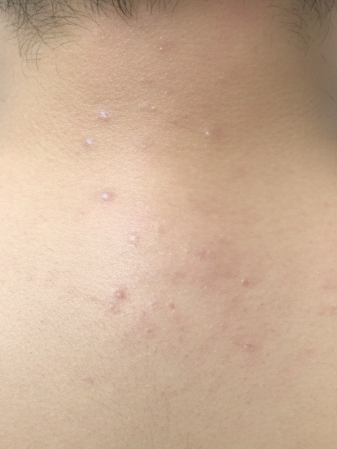 Elevexo Skin exosome therapy for skin rejuvenation and healthier skin