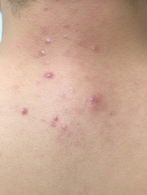 Elevexo Skin Exosome Therapy Treatment